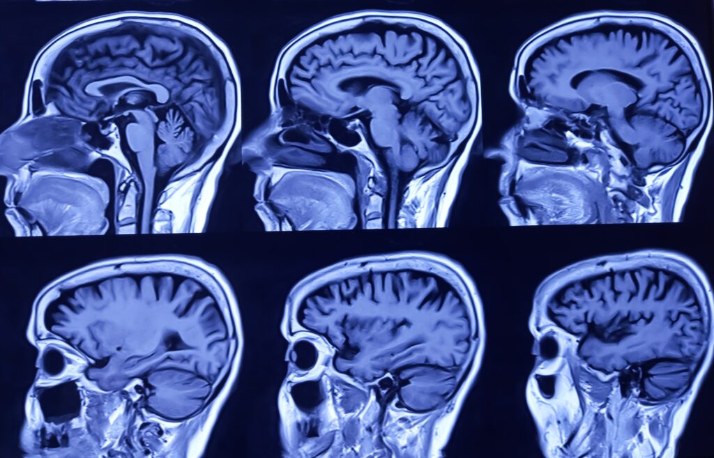 ‘Exciting’ Clinical Trial Finds MS Drug Combo Can Repair Nerve Damage – But Benefits Not Yet Felt by Patients